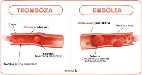 Infografika ukazujúca vzťah medzi koagulopatiou, trombózou a emboliou, plus hlavné orgány postihnuté trombom