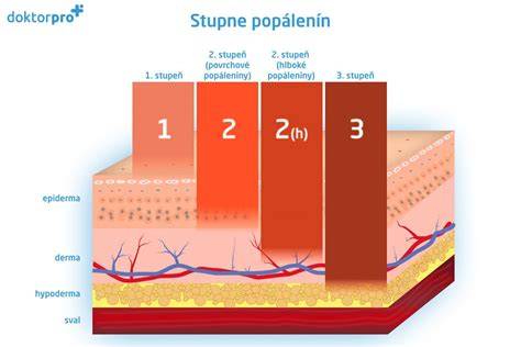 Infografika: Stupne popálenín a ich charakteristiky