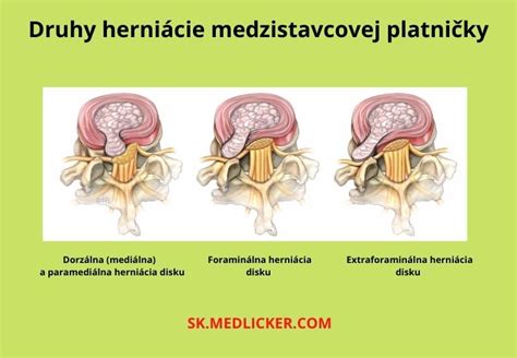 Vizualizácia vyklenutia a výhrezu medzistavcovej platničky