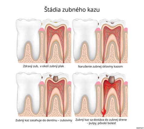Zubný kaz na mliečnom zube