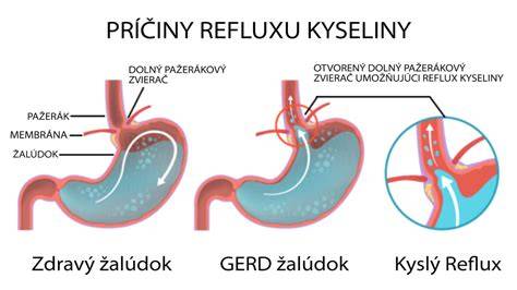 Infografika: Ako funguje reflux a LES