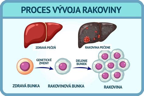 Hemangióm pečene - obrázok charakteristický MR/CT signálov