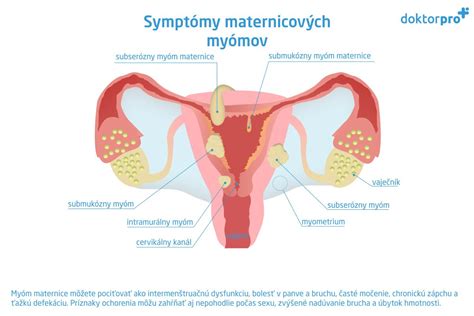 Ultrazvukový snímok maternice s myómom