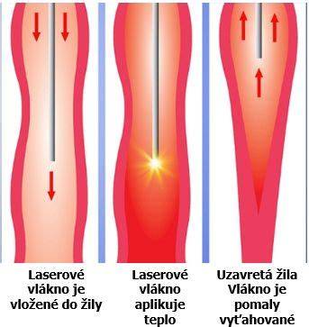 Infografika: Mechanizmus vzniku kŕčových žíl a liečebné prúdy