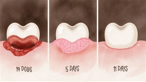Štruktúra dentálnej hygieny po extrakcii zuba