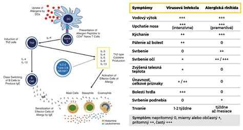 Schéma prejavov alergickej rinitídy