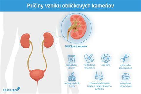 Infografika o typoch obličkových kameňov a ich zložení