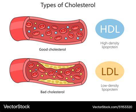 Infografika: LDL vs HDL, kde sa LDL uklada na steny tepien a HDL ich odstraňuje